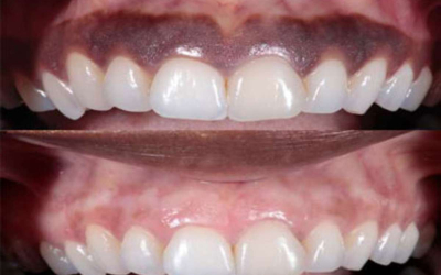 Depigmentation of gums