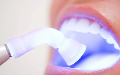 LASER Teeth Whitening